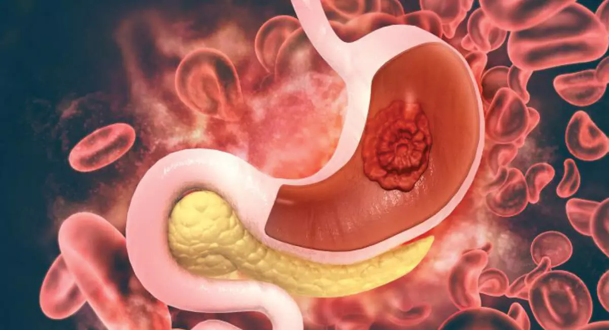 Stomach Cancer