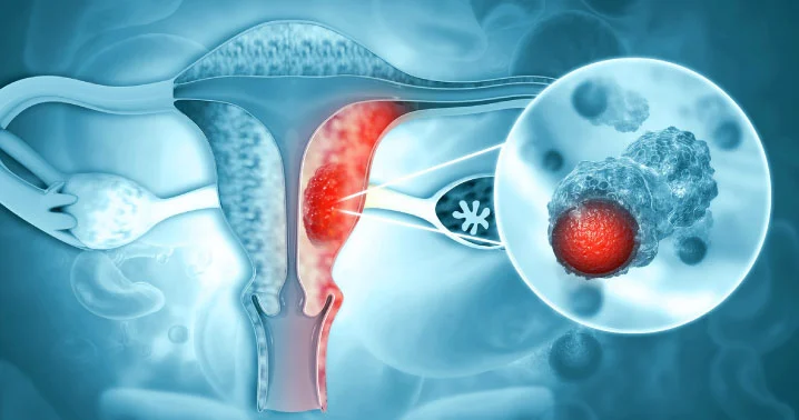 Endometrial Cancer