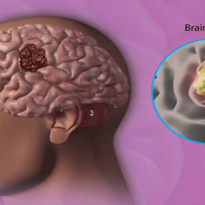 Tumours of the Nervous System: Brain Tumour