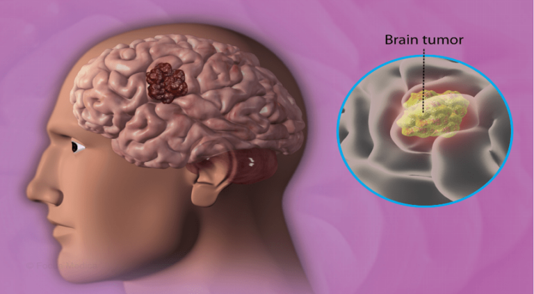 Tumours of the Nervous System: Brain Tumour