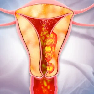 Uterine Cancer